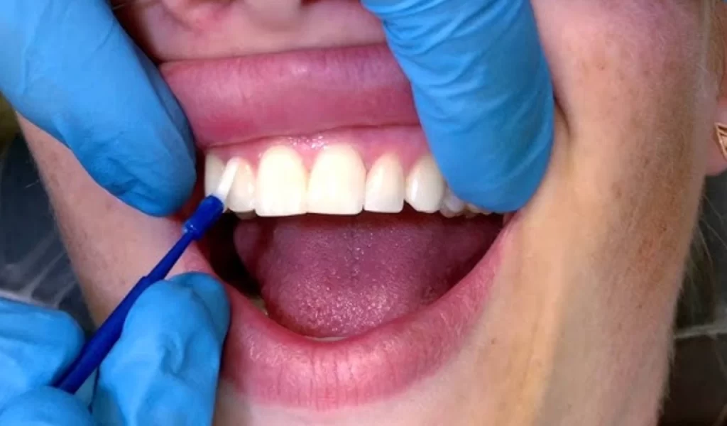 Fluoride Application