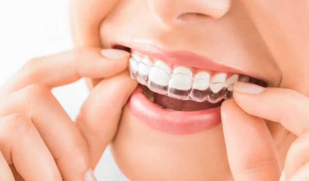 Invisalign Aliners
