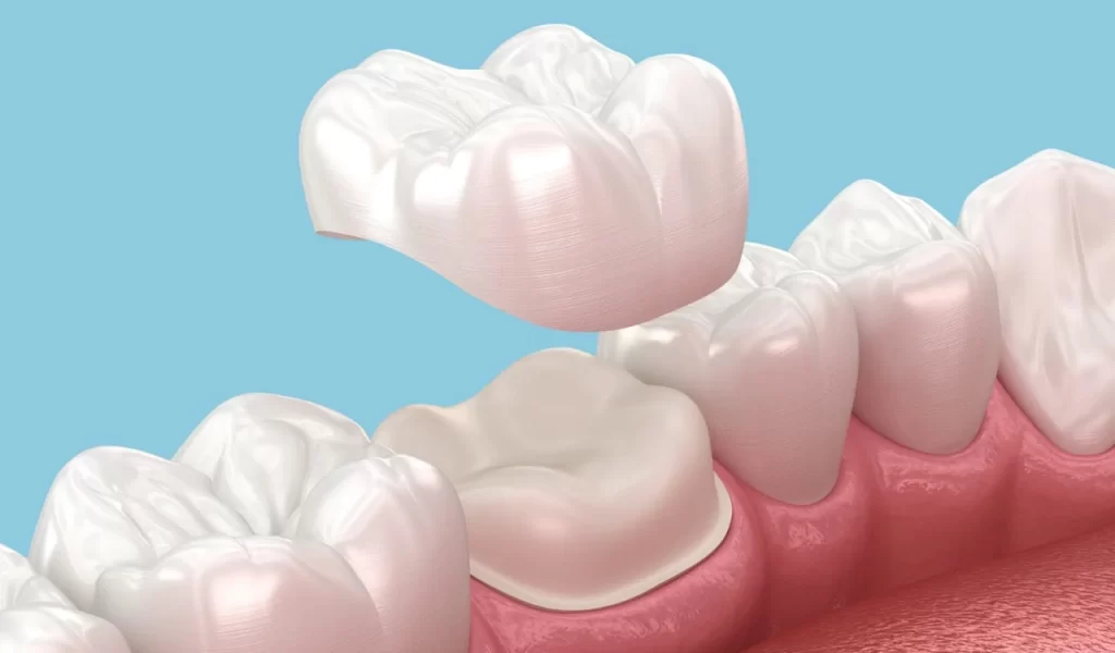 Molar Crown
