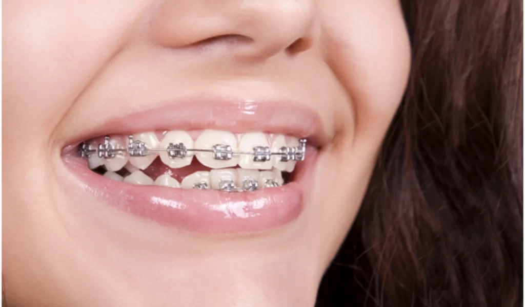 Orthodontic t_t