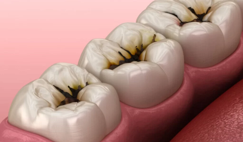 Pit And Fissure Sealent