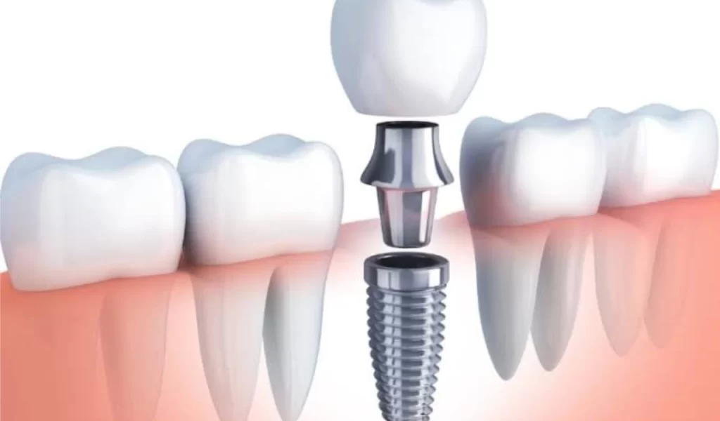 Root Canal Treatment