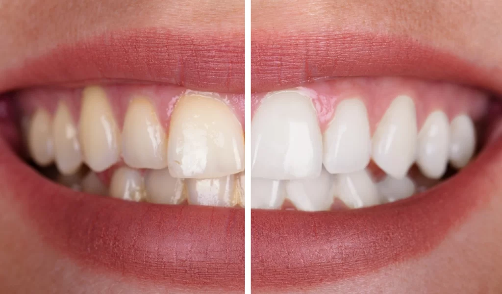 Teeth Cleaning
