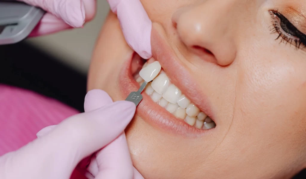 Tooth Coloured Crown